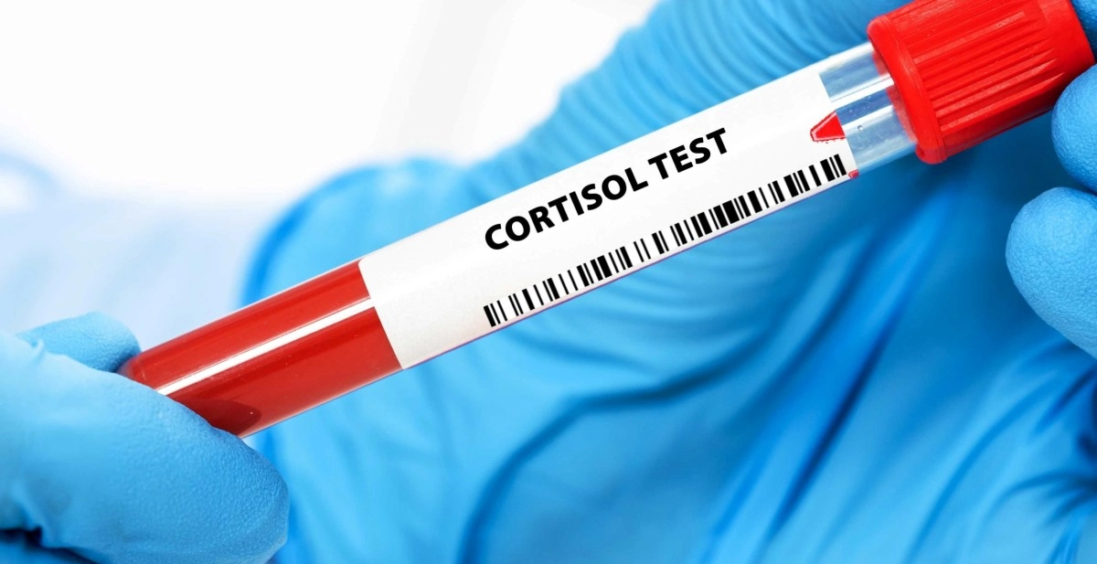 Cushing039s syndrome a silent disease that can be fatal without timely treatment