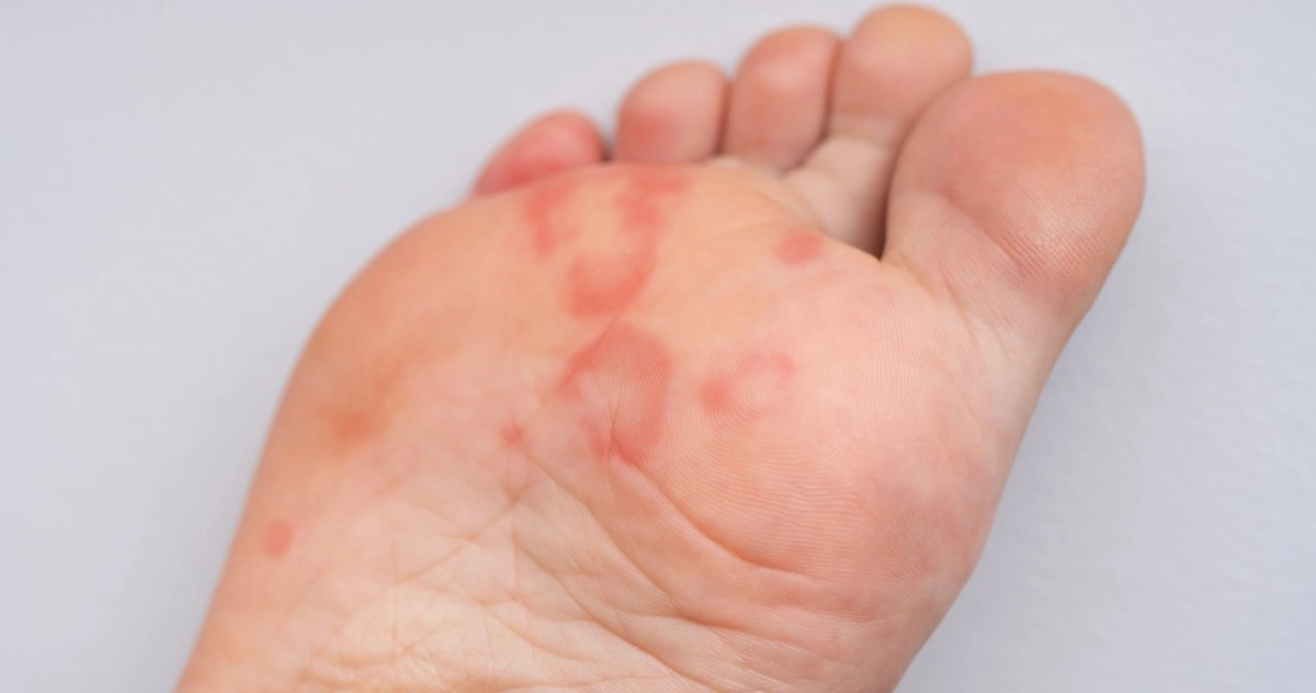 Red spots on the feet why they appear and how to treat them