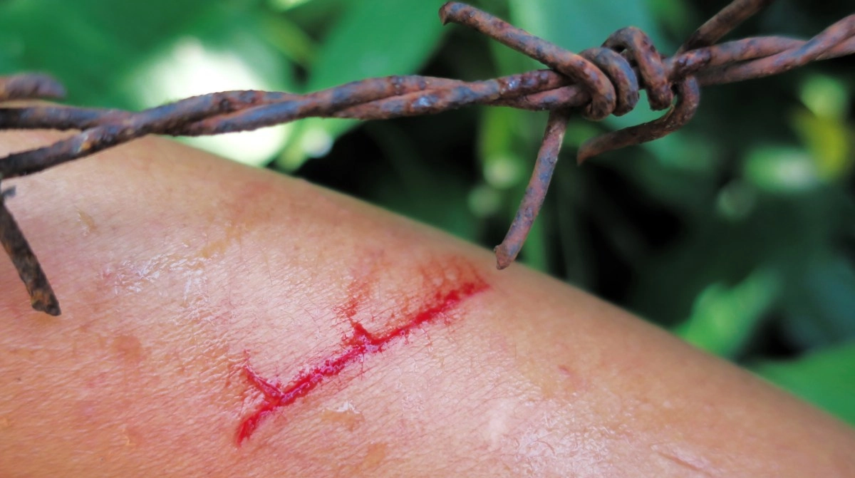 Cases of tetanus are increasing it is a rare but dangerous disease