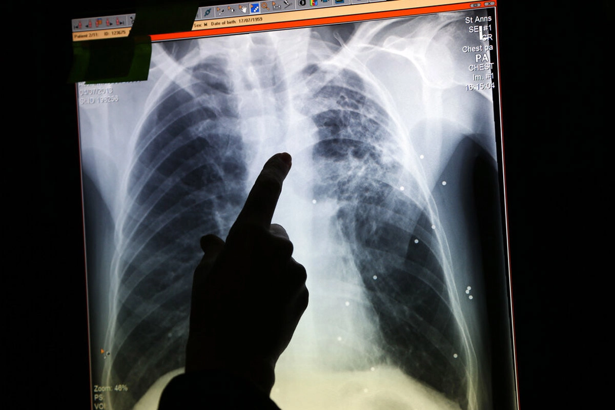 Health authorities investigate tuberculosis infections in an immigration detention center