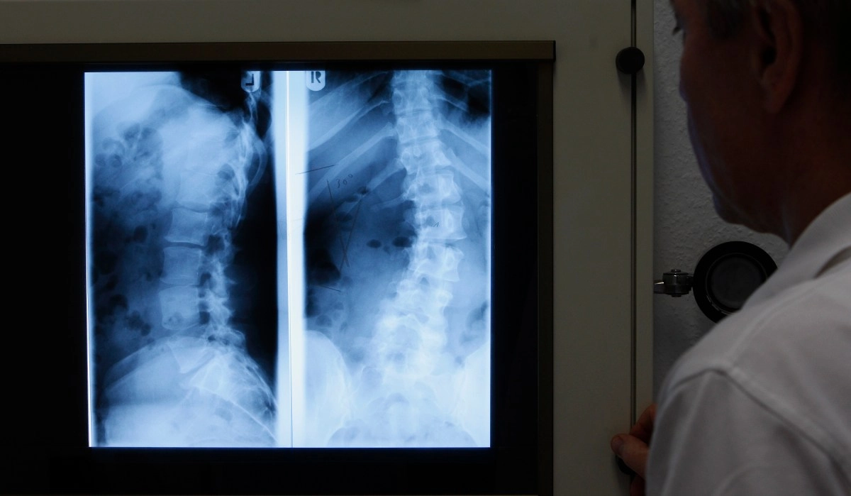 12yearold Hispanic woman walks after recovering from a spinal cord injury in Southern California