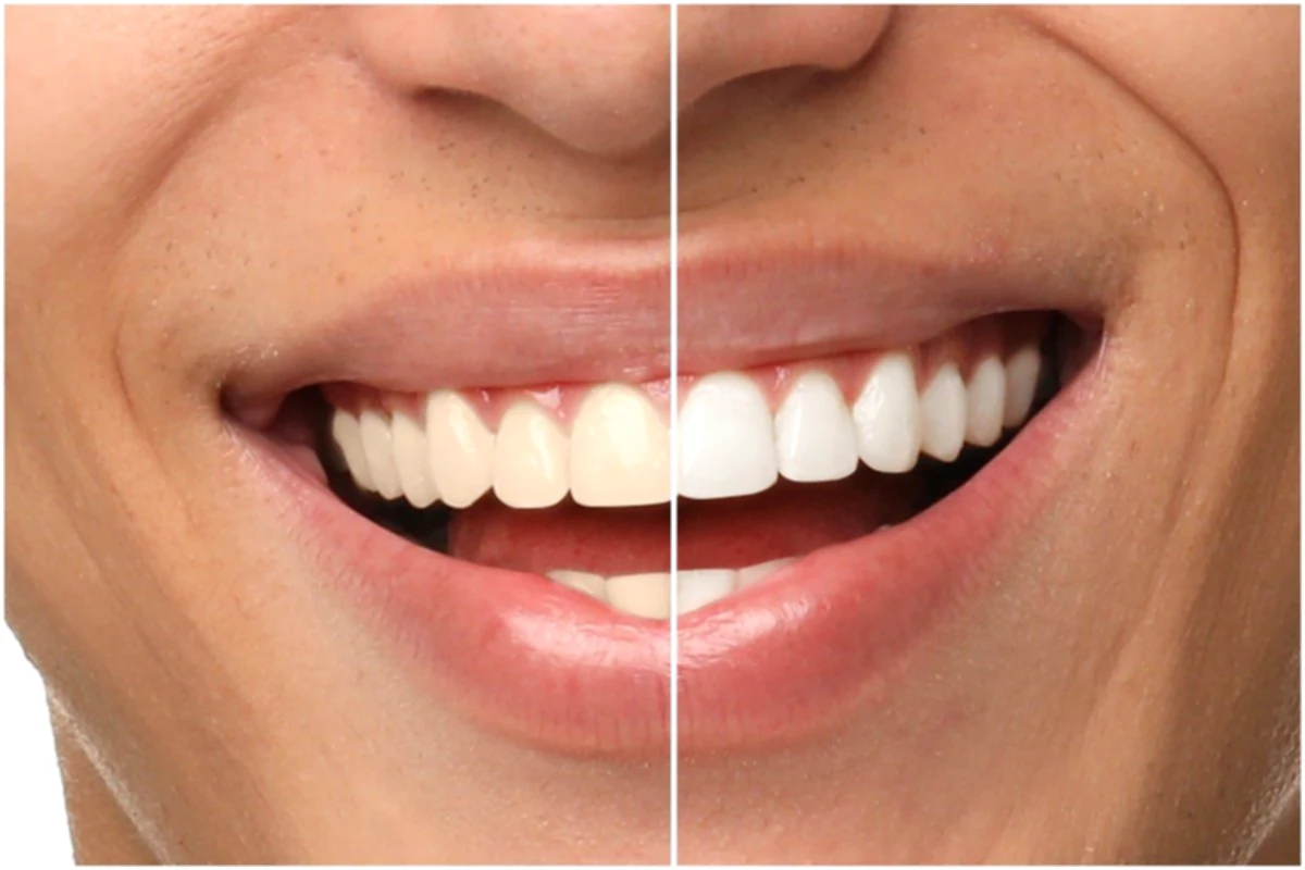 Whitening your teeth: 3 risks that no one tells you about