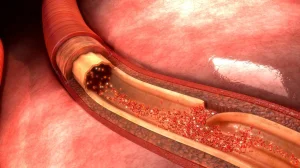 Aortic dissection can cause serious internal bleeding: rare heart condition caused death of Senator Graham