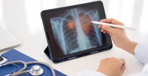 Significant increase in lung cancer in non-smokers